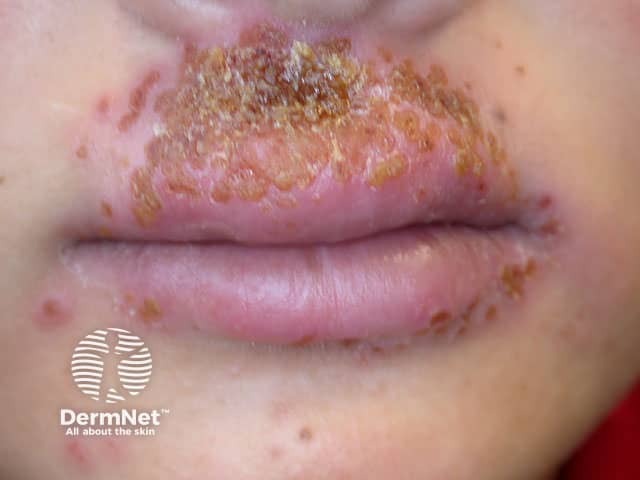 Герпетическая экзема: множественные эрозии и везикулы