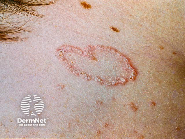 Папулы, покрытые корками, с кольцевидным расположением на коже шеи при серпигинирующем перфорирующем эластозе