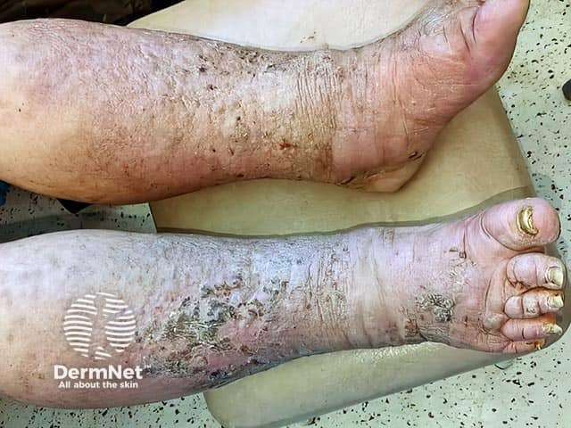 Бородавчатая слоновость нострас (elephantiasis nostras verrucosa): выраженный лимфедематозный отек пальцев стопы, лодыжек и голеней с узловыми элементами и гиперкератозом