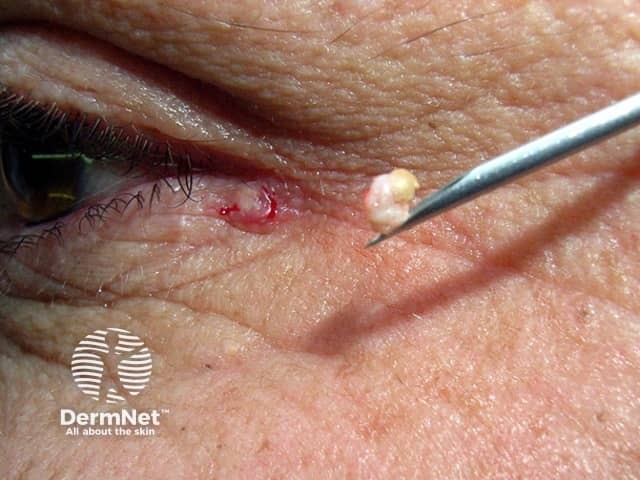 Эвакуация содержимого небольшой эпидермоидной кисты века после прокола иглой