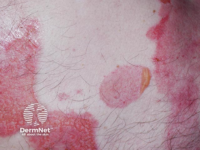 Крупные вялые пузыри на голени при приобретенном буллезном эпидермолизе