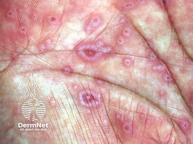Малая форма многоформной эритемы (erythema multiforme minor)