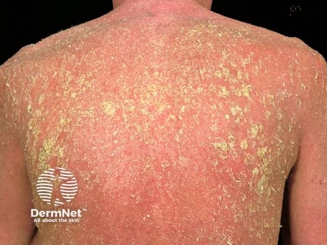 Эритродермия: тотальное поражение кожи с пластинчатым шелушением