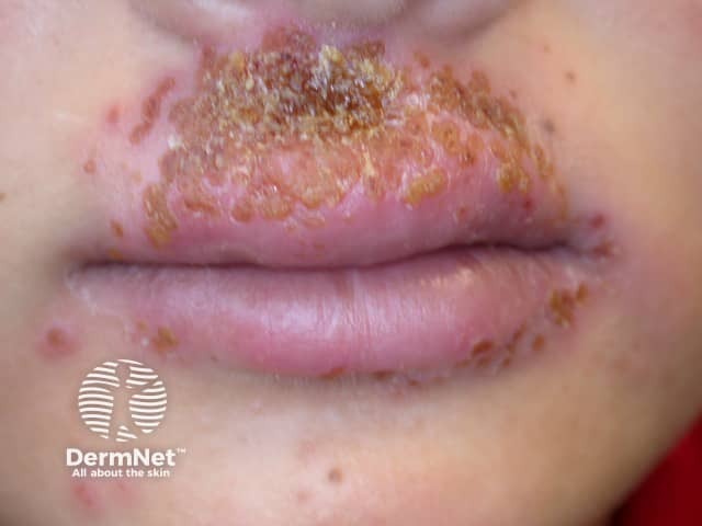 Простой герпес (Herpes simplex): сгруппированные везикулы на эритематозном основании