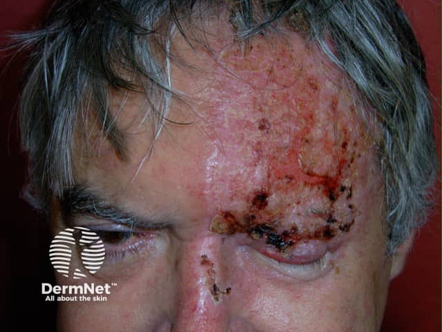 Опоясывающий герпес (Herpes zoster): везикулезная сыпь по ходу ветви тройничного нерва