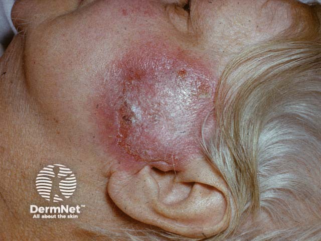 Очаг фиксированной токсикодермии на щеке; разрешился с исходом в поствоспалительную гиперпигментацию