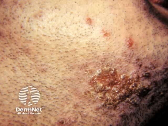 Вульгарный сикоз (Sycosis barbae)
