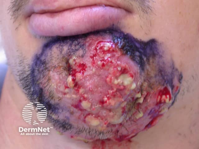 Вульгарный сикоз (Sycosis barbae)
