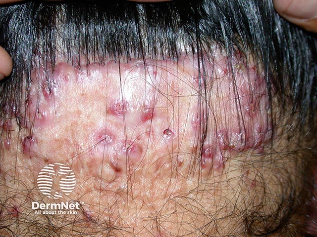Рубцовые изменения, узлы и алопеция на задней поверхности шеи при келоидном фолликулите затылка