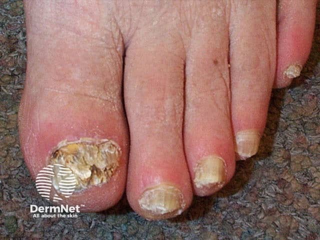 Микоз ногтей стоп (tinea unguium)