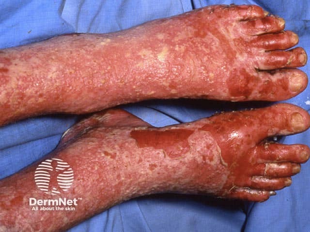 Крупные сливные «гнойные озера» и эрозии на нижних конечностях при эритродермической форме генерализованного пустулезного псориаза
