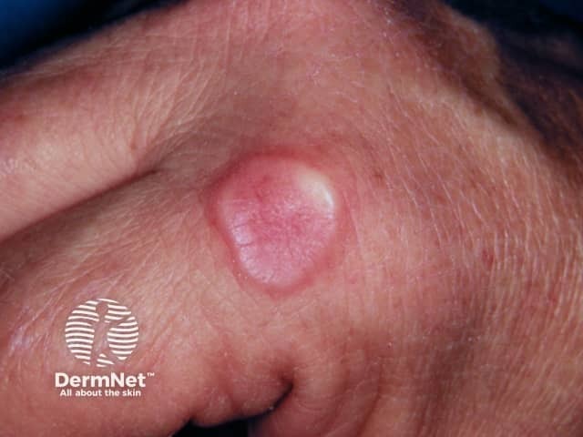 Кольцевидная гранулема (Granuloma annulare)
