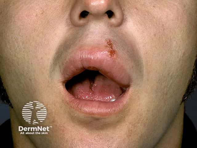 Отек и образование трещин верхней губы при гранулематозном хейлите