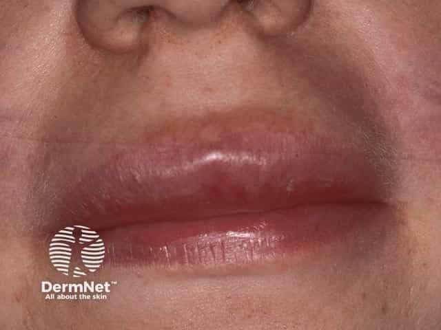 Отек верхней губы при гранулематозном хейлите