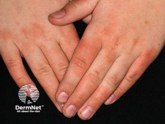 Дерматит тыльной поверхности пальцев у мальчика с атопией