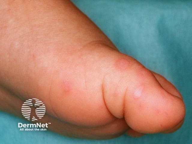 Овальные везикулы на подошве при синдроме «рука — нога — рот»