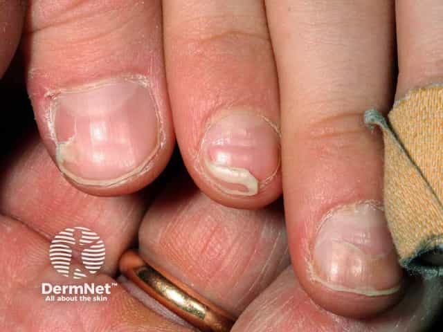 Онихомадезис вследствие энтеровирусной инфекции