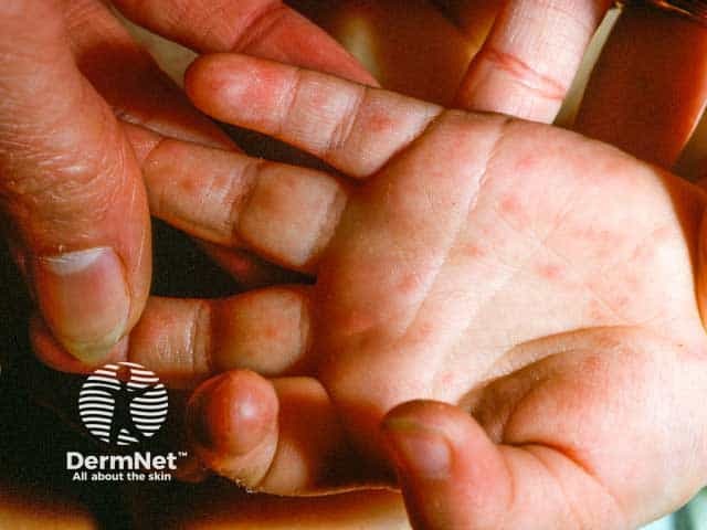 Превезикулезные высыпания на ладонях в ранней стадии синдрома «рука — нога — рот»