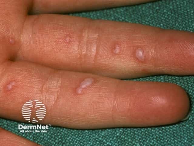 Синдром «рука — нога — рот»