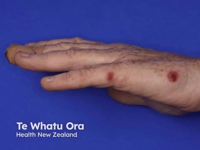 Синдром «рука — нога — рот»