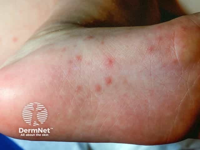 Превезикулезные высыпания на подошвах при синдроме «рука — нога — рот»
