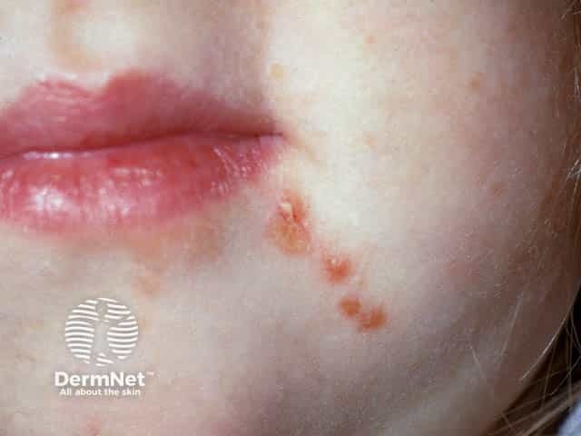 Везикулы на лице при синдроме «рука — нога — рот»