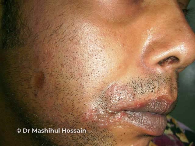 Лабиальный герпес (Herpes labialis)