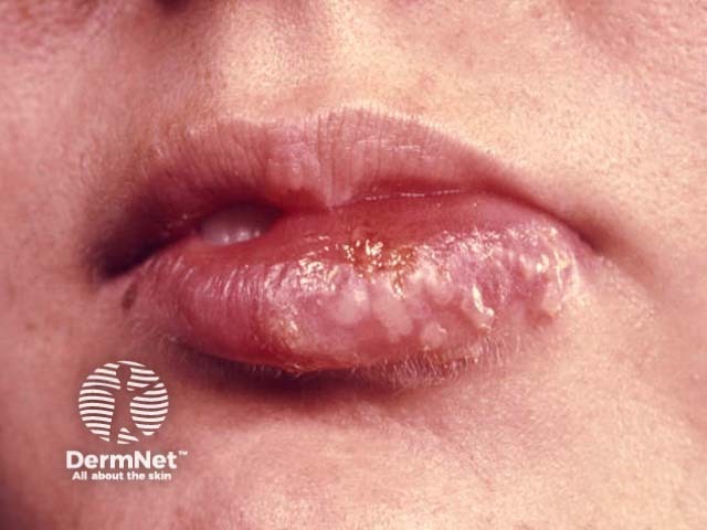 Лабиальный герпес (Herpes simplex labialis)