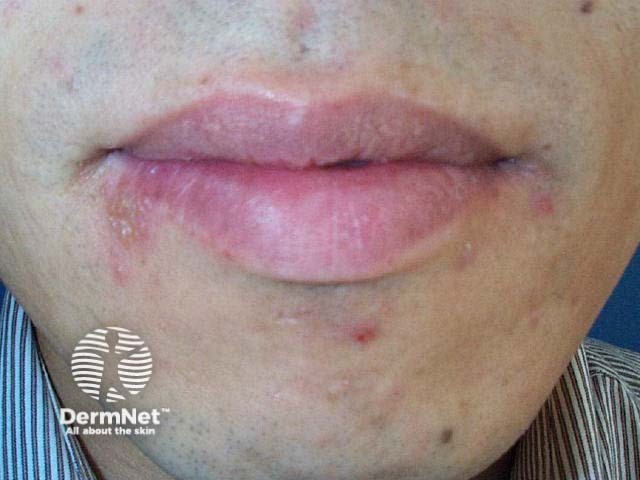 Лабиальный герпес (Herpes simplex labialis)