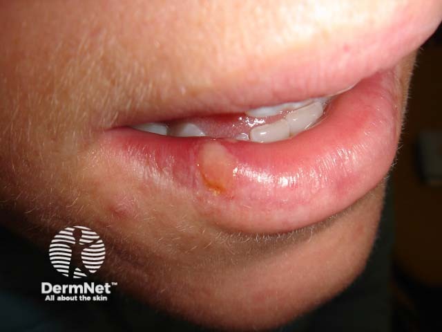 Лабиальный герпес (Herpes simplex labialis)