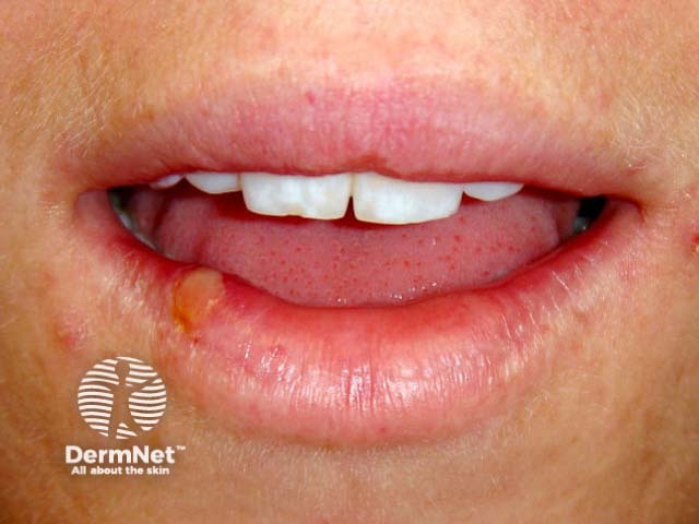 Лабиальный герпес (Herpes simplex labialis)