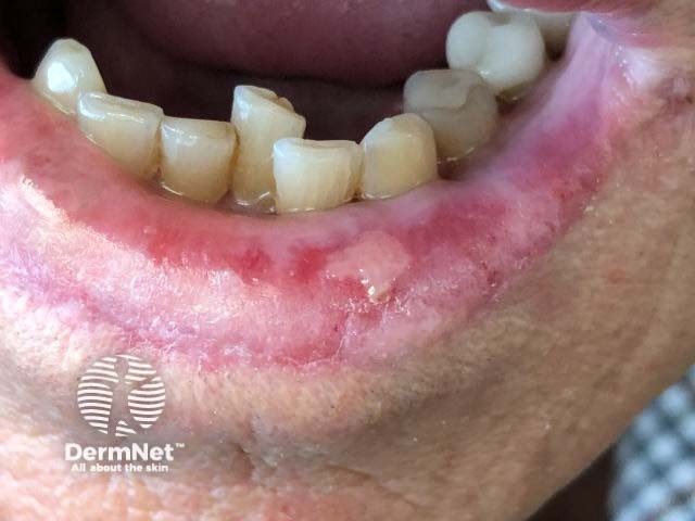 Лабиальный герпес (Herpes simplex labialis)