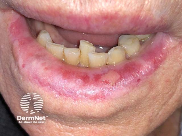 Лабиальный герпес (Herpes simplex labialis)