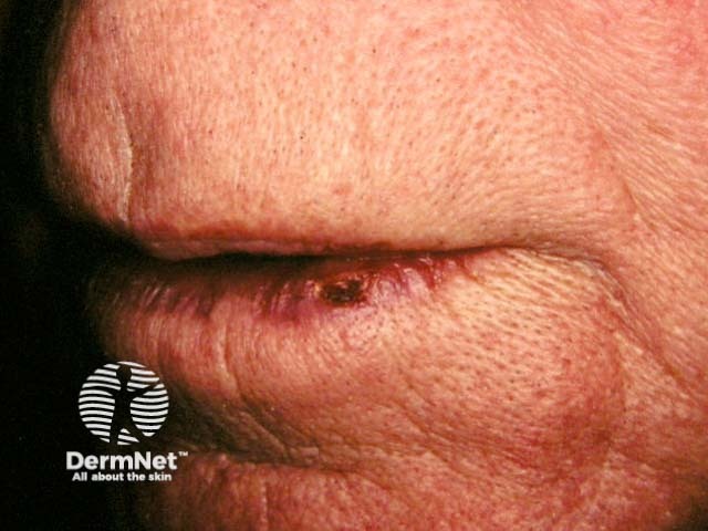 Лабиальный герпес (Herpes simplex labialis)