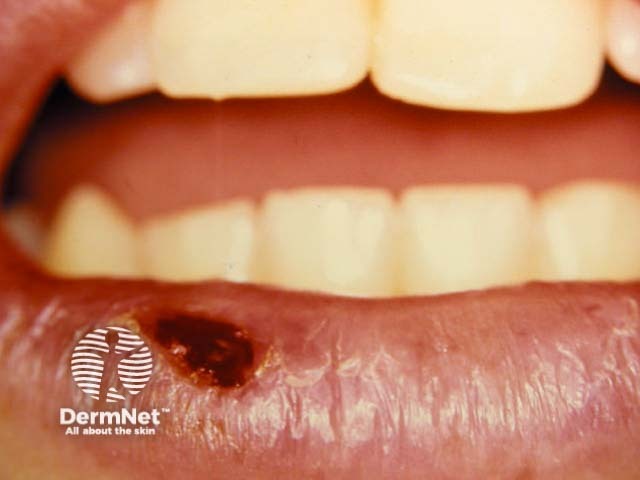 Лабиальный герпес (Herpes simplex labialis)