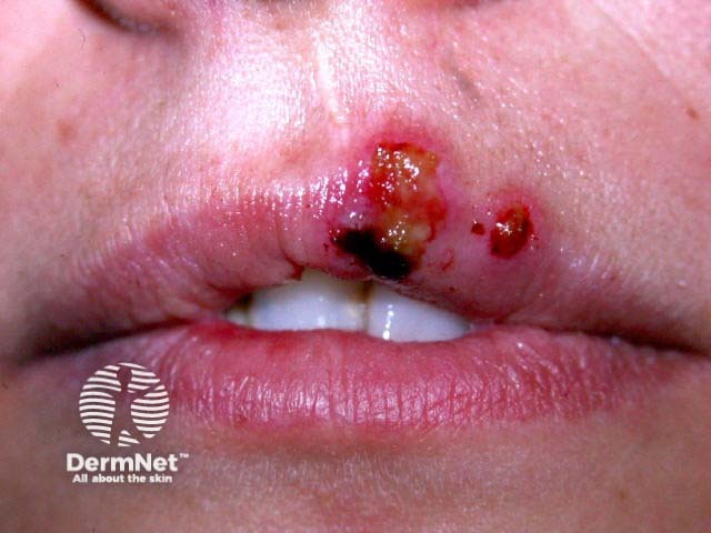 Лабиальный герпес (Herpes simplex labialis)