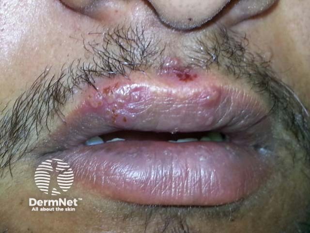 Лабиальный герпес (Herpes simplex labialis)