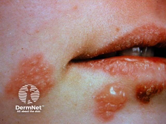 Лабиальный герпес (Herpes simplex labialis)