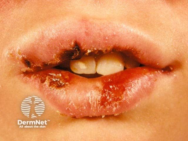Лабиальный герпес (Herpes simplex labialis)