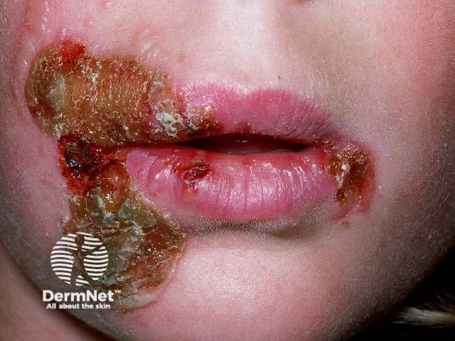 Лабиальный герпес (Herpes simplex labialis)