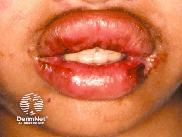 Лабиальный герпес (Herpes simplex labialis)