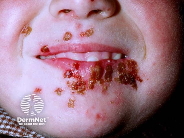 Лабиальный герпес (Herpes simplex labialis)