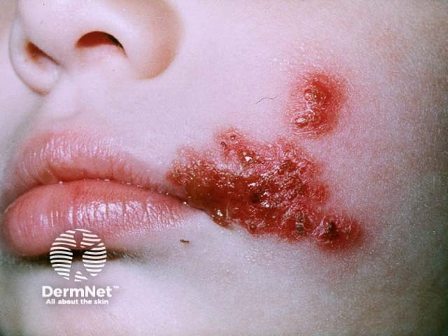 Лабиальный герпес (Herpes simplex labialis)