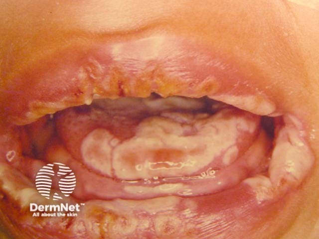 Лабиальный герпес (Herpes simplex labialis)