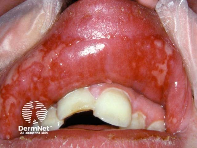 Лабиальный герпес (Herpes simplex labialis)