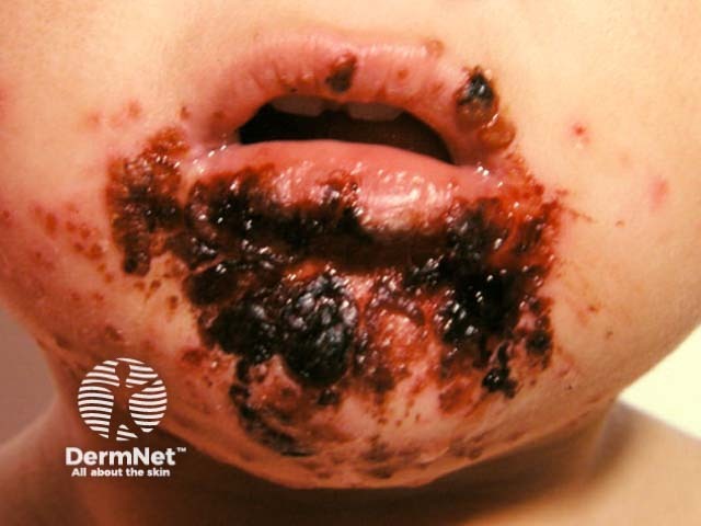 Лабиальный герпес (Herpes simplex labialis)