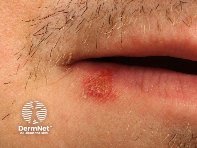 Лабиальный герпес (Herpes simplex labialis)