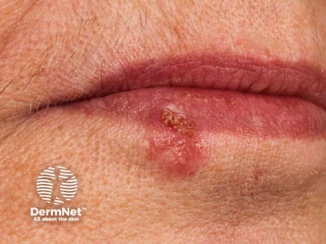 Лабиальный герпес (Herpes simplex labialis)