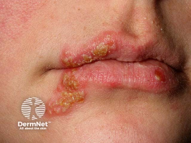 Лабиальный герпес (Herpes simplex labialis)