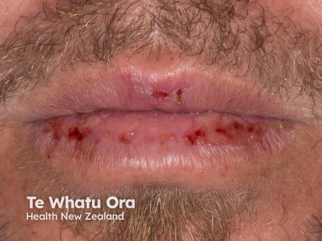 Лабиальный герпес (Herpes simplex labialis)